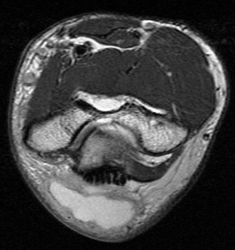 Figure 2 for case olecranon bursitis ( RID2082 )